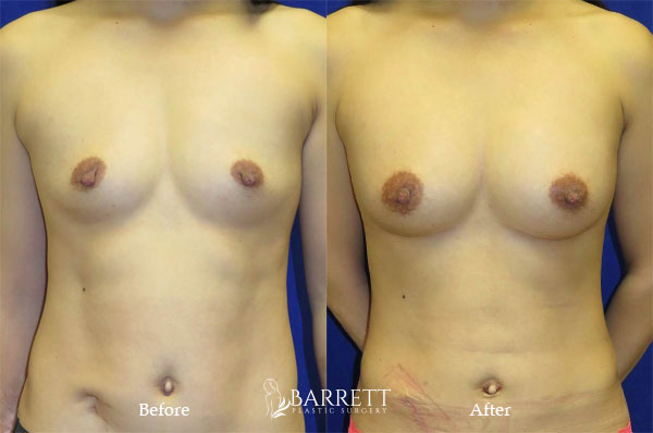 Natural Breast Augmentation Using Fat Beverly Hills